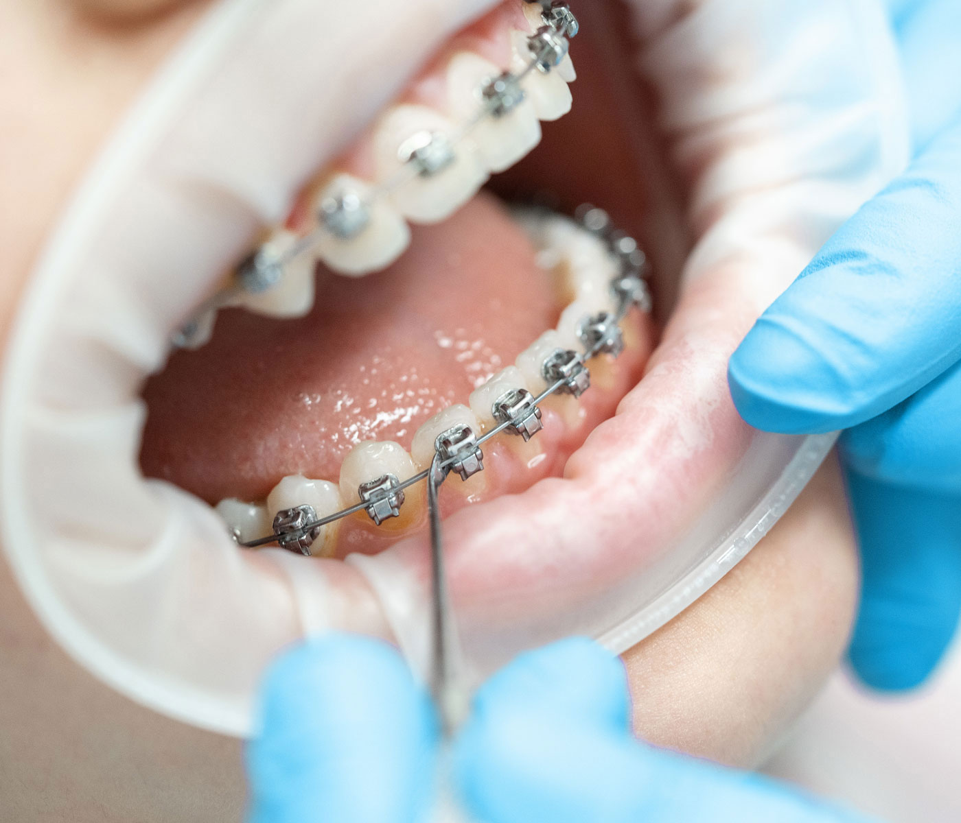 Fixed braces fitting
